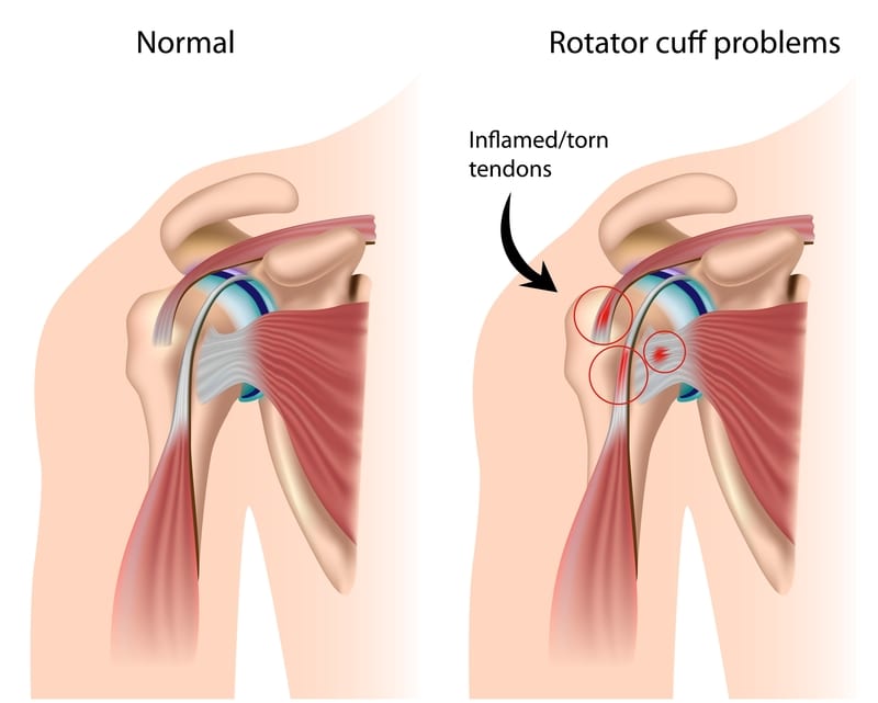 Rotator Cuff Tendinopathy Advanced Training And Rehab